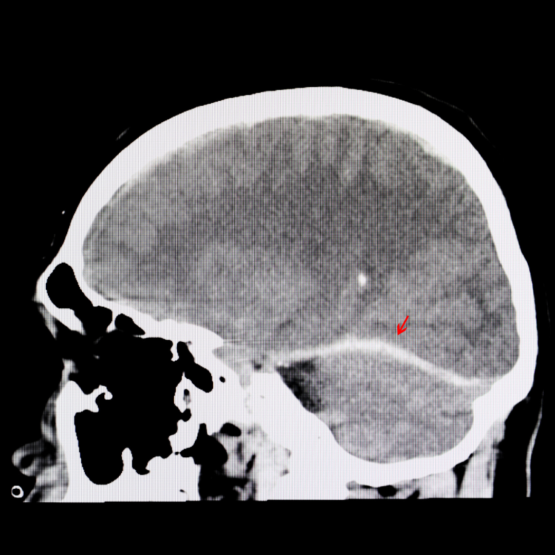 Lesiones Catastróficas Image